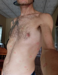 Tinea Corporis Ringworm